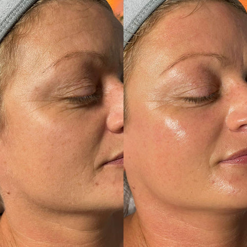 Radiant Glow Duo Peeling Kit™